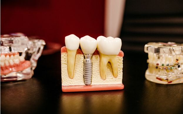 Single Tooth Implant TX