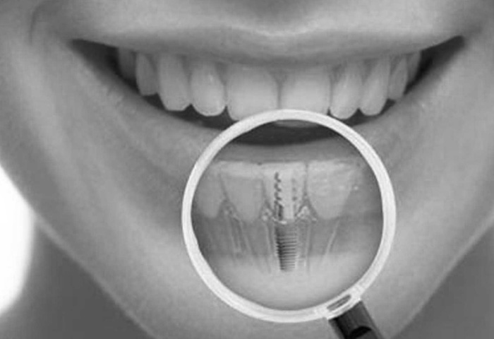 Implant Dentistry