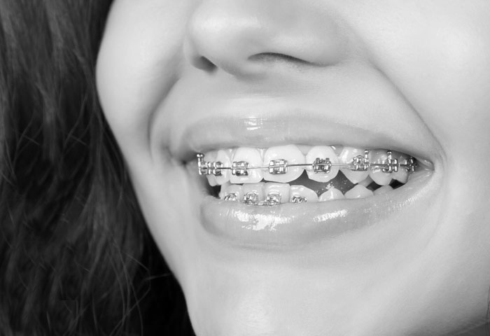 Orthodontics/Braces