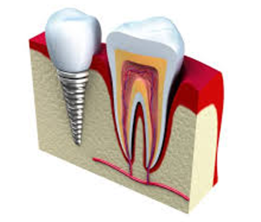 Single Tooth Implant TX
